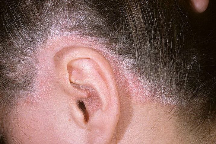 Kulakların arkasındaki kafada sedef hastalığı patlamaları