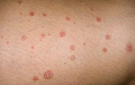 Psoriatik plaklar
