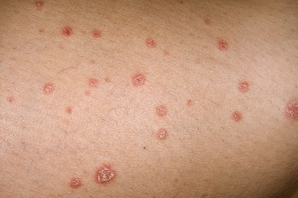 Psoriatik plaklar