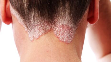 Kafa derisindeki psoriatik plaklar