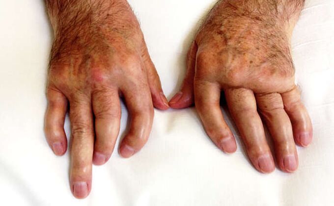 Sedef hastalığında sakatlayıcı artrit