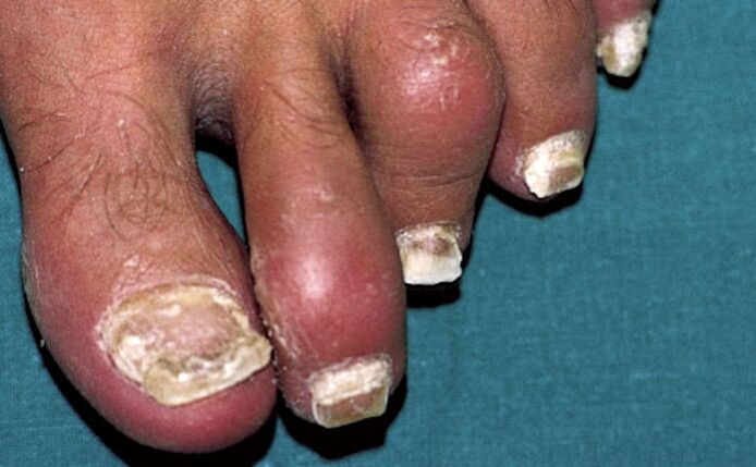 Tırnak tutulumu ve ayak parmaklarında eklem iltihabı (artrit) ile seyreden sedef hastalığı